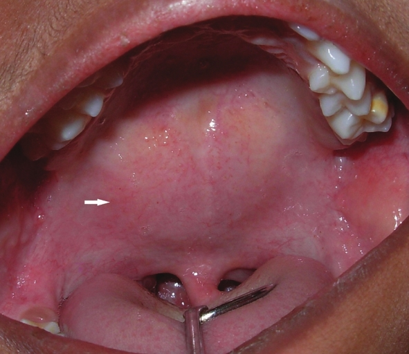 Well-circumscribed, ovoid swelling (arrow) is seen in the midline of the soft palate.